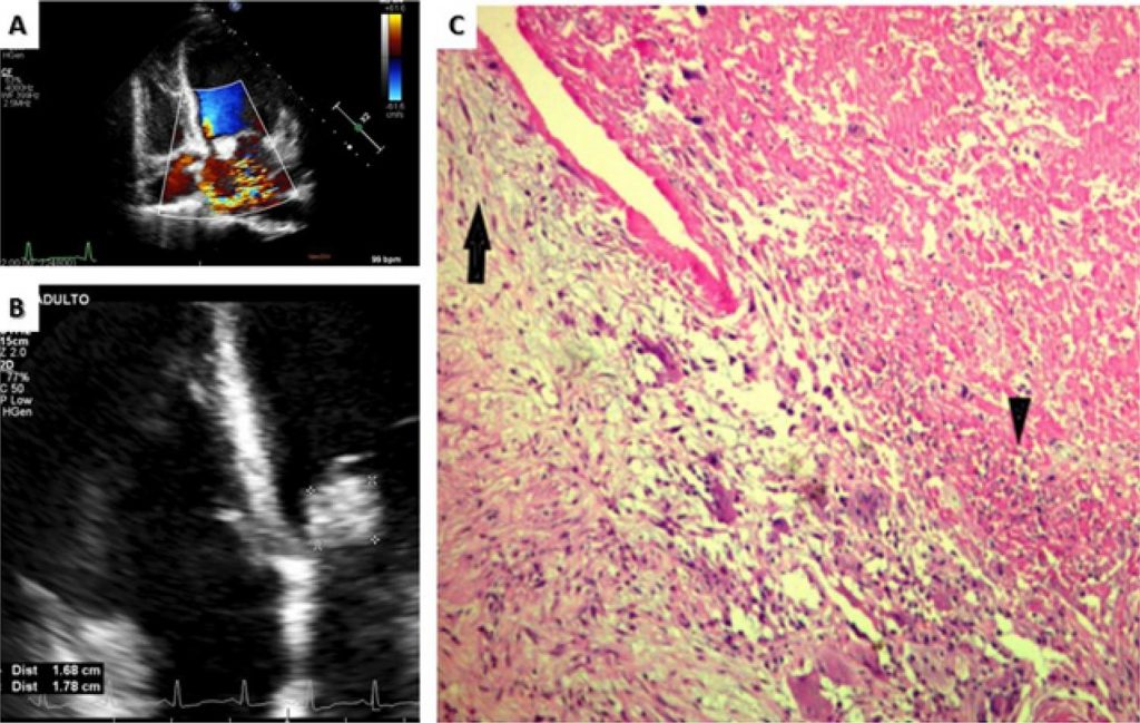 Mitral Valve Mass in a Patient Suspected of Systemic Lupus Tumor