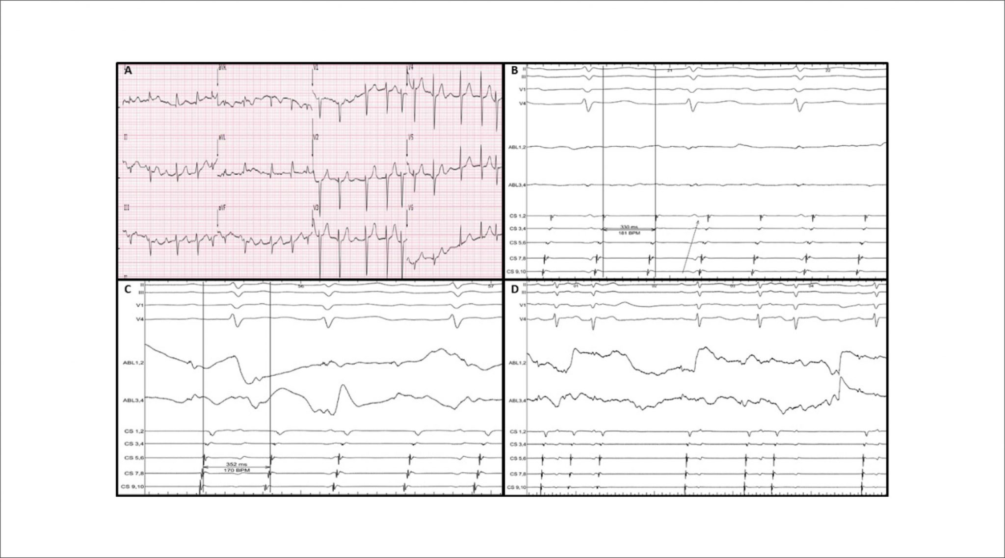 Coherent Map for Atypical Atrial Flutter – A Step Forward for the ...