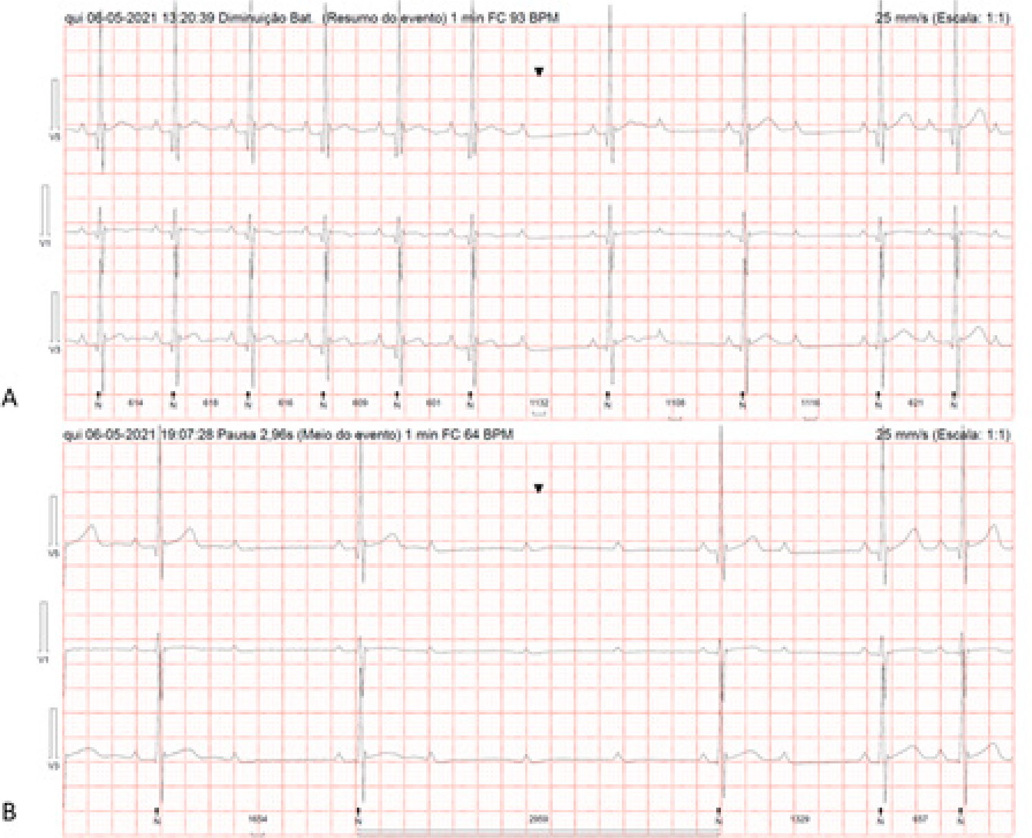 An Unusual Presentation of Lyme Carditis and AdenosineSensitive
